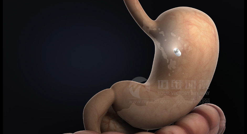 醫學(xué)醫療三維動(dòng)畫(huà) 醫學(xué)醫療三維動(dòng)畫(huà)