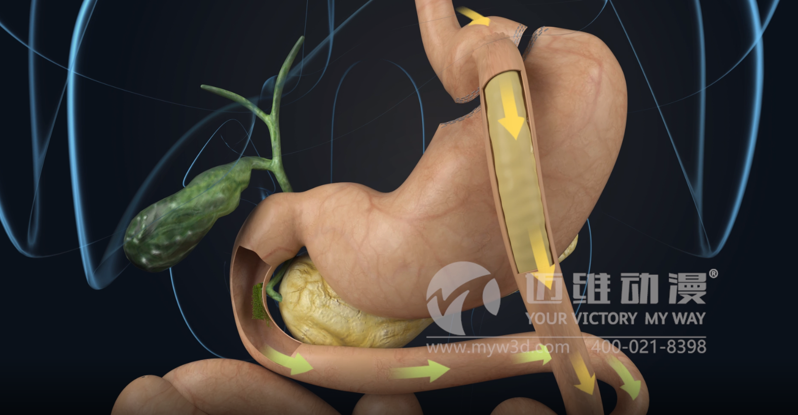 熱烈祝賀邁維動(dòng)漫與杭州糖吉醫療科技有限公司圓滿(mǎn)完成胃轉流支架系統三維動(dòng)畫(huà)項目合作！(圖2)