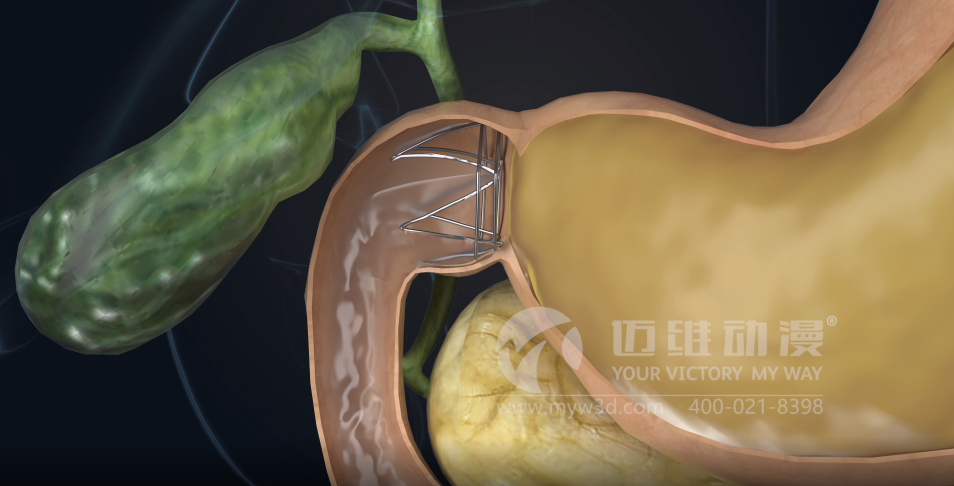 熱烈祝賀邁維動(dòng)漫與杭州糖吉醫療科技有限公司圓滿(mǎn)完成胃轉流支架系統三維動(dòng)畫(huà)項目合作！(圖3)