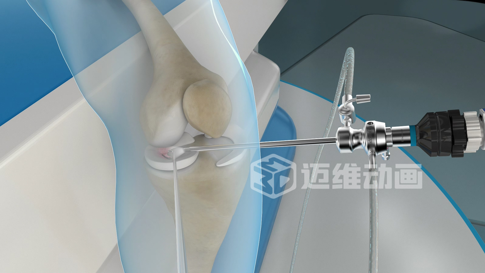 關(guān)節鏡手術(shù)三維動(dòng)畫(huà)
